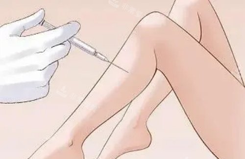 注射瘦腿示意图 注射瘦腿示意图