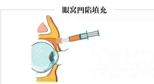 眼窩凹陷填充