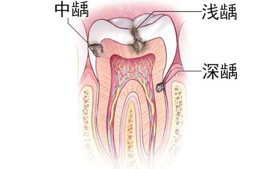 牙齿龋齿深浅图