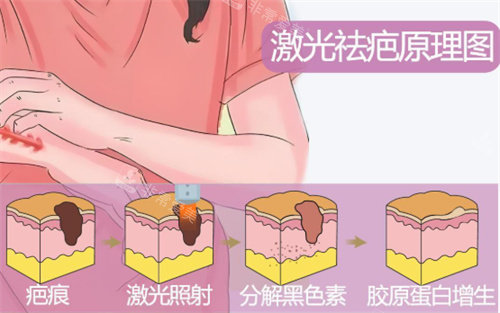 激光祛疤原理示图