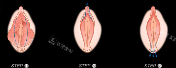 阴唇塑造照片