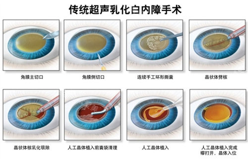 白内障超声乳化手术流程图