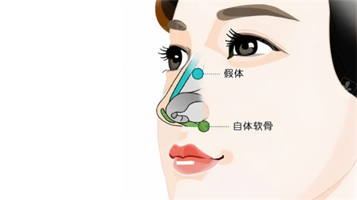 隆鼻卡通示图