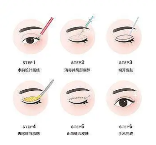 全切双眼皮流程图示
