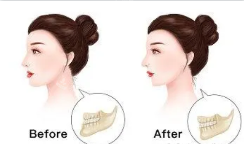 正頜手術(shù)后的成效圖片 正頜手術(shù)后的成效圖片