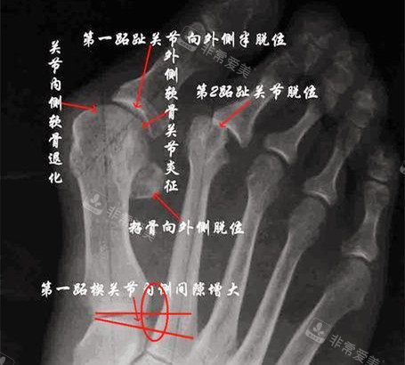 大脚骨X光片