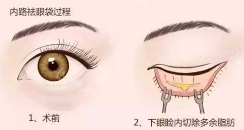 鄭州王楊醫(yī)生眼袋修復(fù)...
