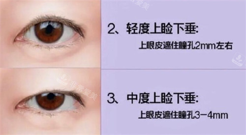 上瞼下垂自測(cè)圖 上瞼下垂自測(cè)圖