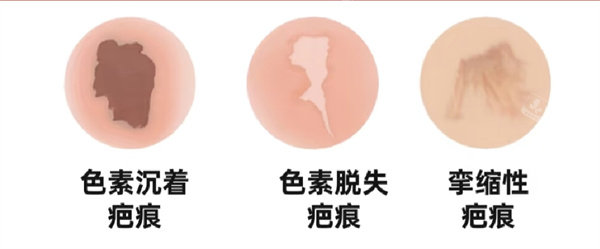 疤痕圖片 疤痕圖片