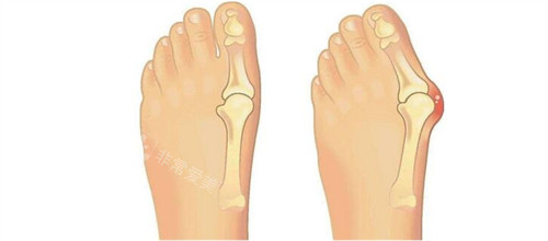 大腳骨手術(shù)前后對比 大腳骨手術(shù)前后對比