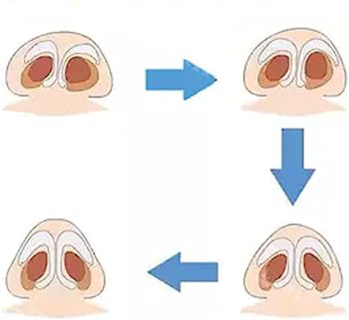 歪鼻 歪鼻