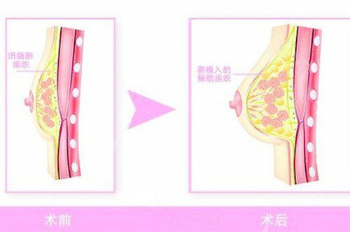 自體脂肪隆胸圖片 自體脂肪隆胸圖片