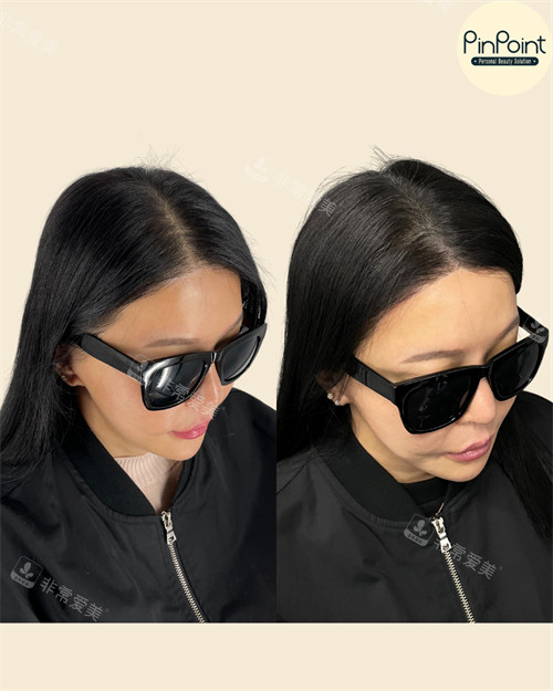 Pinpoint Lab紋發(fā)縫前后對(duì)比