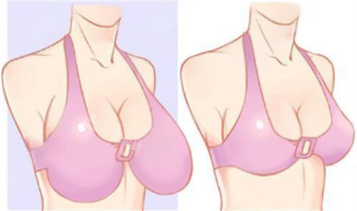 巨乳缩小术