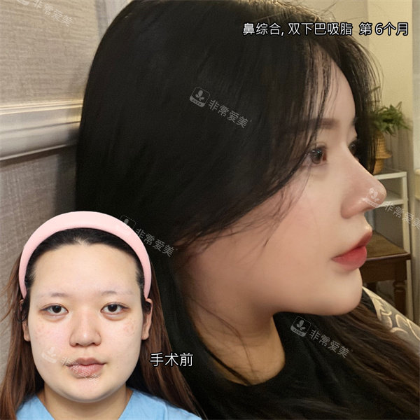 韓國答必達整形外科鼻整形對比照 韓國答必達整形外科鼻整形對比照
