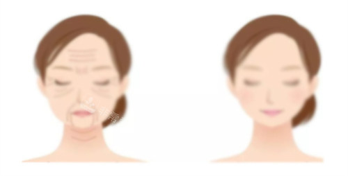 熱瑪吉提升前后對(duì)比 熱瑪吉提升前后對(duì)比