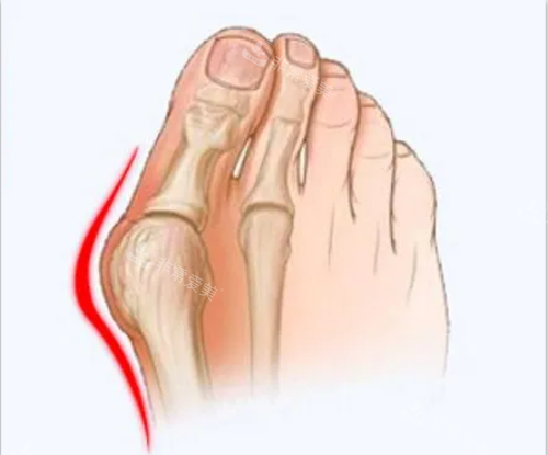 大腳骨圖片 大腳骨圖片