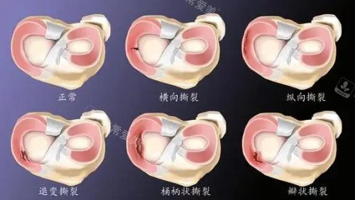 半月板损伤各种形态