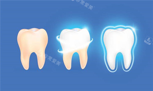 牙齿清洗后变白