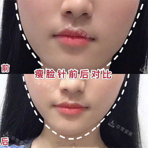 西安画美整形医院瘦脸<span style=