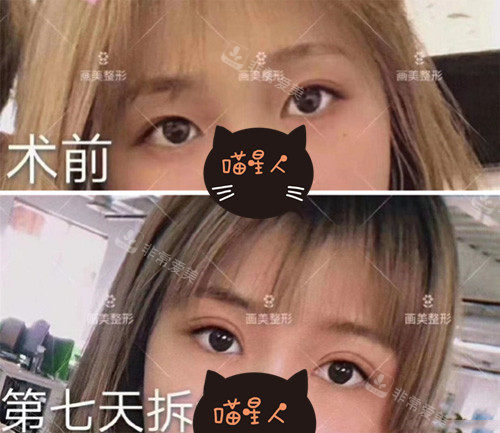 西安画美整形医院双眼皮<span style=