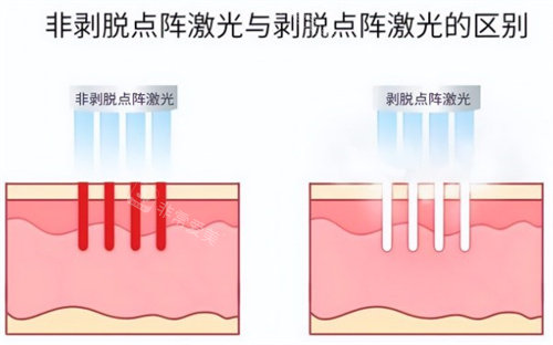 非剝脫點陣激光和剝脫點陣激光 非剝脫點陣激光和剝脫點陣激光