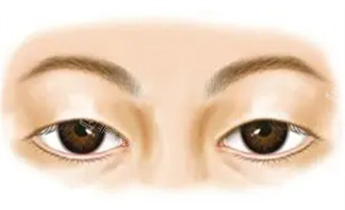 未做手术前的上眼睑下垂 未做手术前的上眼睑下垂