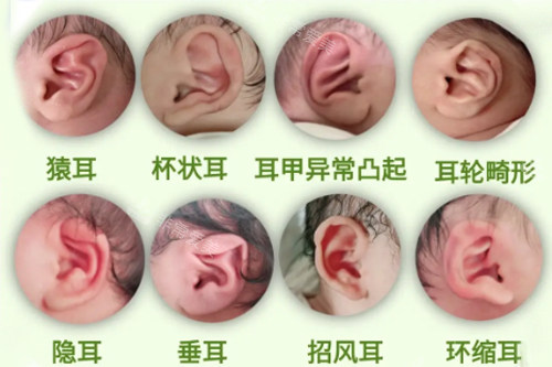 8种耳部畸形图 8种耳部畸形图