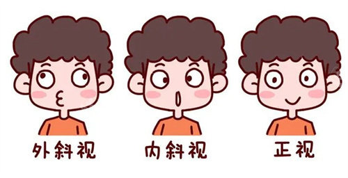 斜视的种类