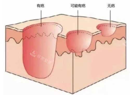 有疤无疤立体图片