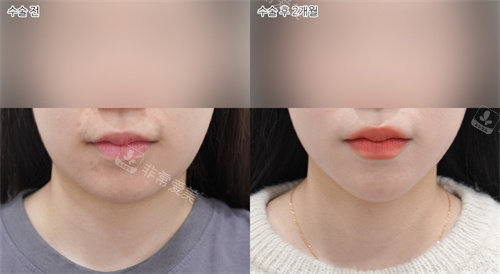 韓國(guó)selfi整形外科做雙下巴前后對(duì)比圖