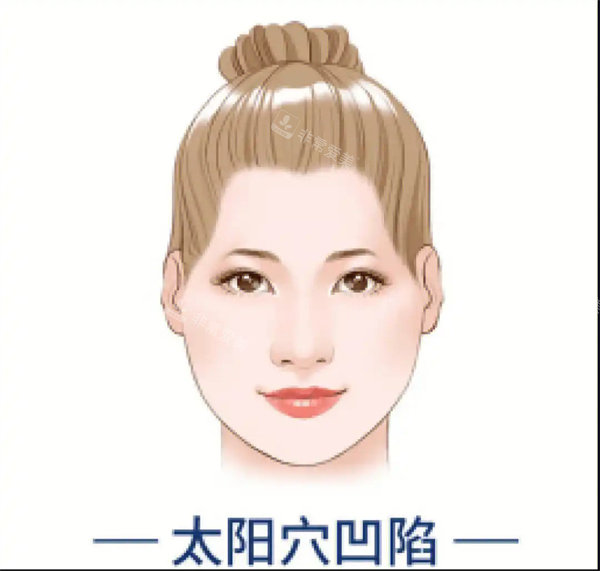 太阳穴凹陷