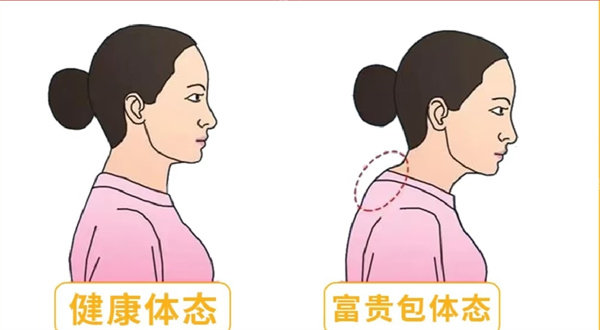 富贵包手术