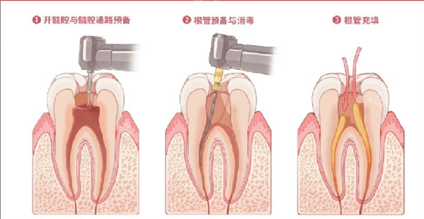 根管治疗展示