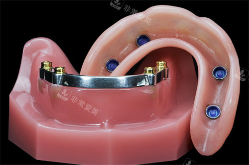 locator半固定种植牙修复种植体
