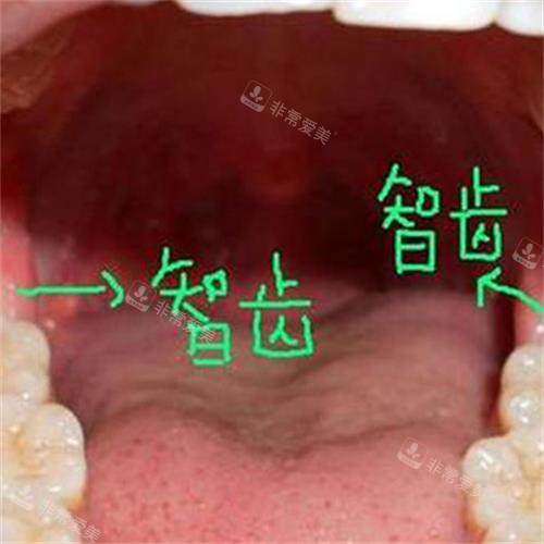 牙齿智齿所在位置