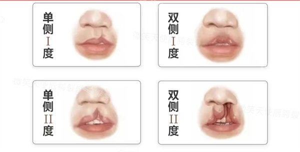 唇裂