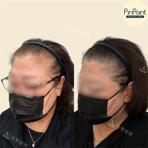 pinpoint lab 纹发际线前后对比右脸 pinpoint lab 纹发际线前后对比右脸
