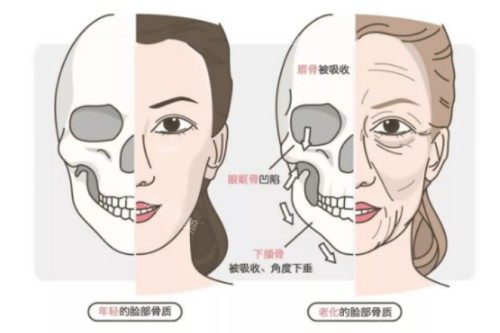年轻、年老脸部骨骼对比图 年轻、年老脸部骨骼对比图