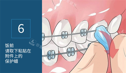 正畸保护蜡使用方法展示图