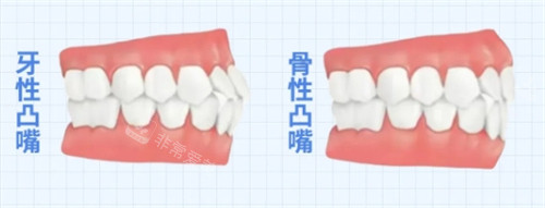 骨性凸嘴和牙性凸嘴 骨性凸嘴和牙性凸嘴