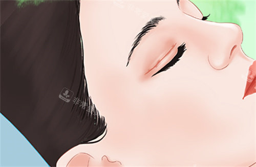 需要双眼皮修复的眼睛