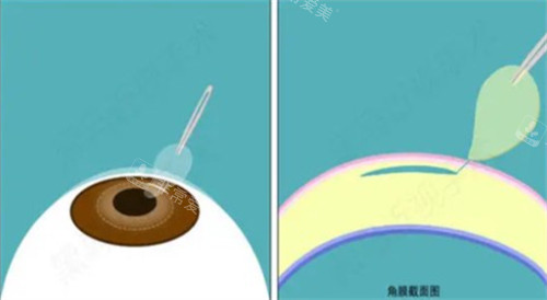 激光近视手术过程图解 激光近视手术过程图解