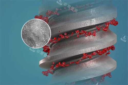 德国ABT种植牙表面结构