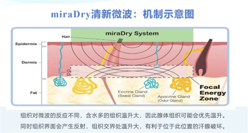 miraDry清新微波机制示意图 miraDry清新微波机制示意图