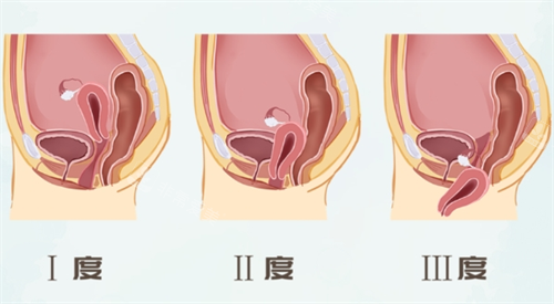 子宫脱垂一二三度对比图 子宫脱垂一二三度对比图