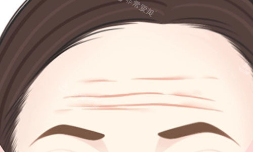 抬头纹的动画图