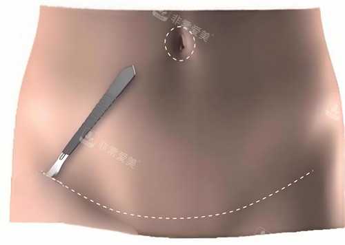 腹壁成形