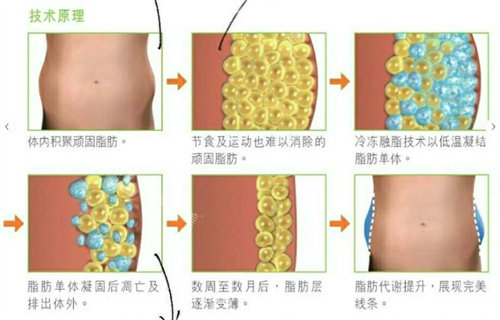 酷塑冷冻溶脂