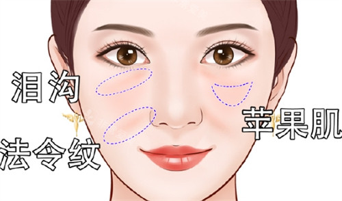 面部凹陷之后所呈现的面部状态